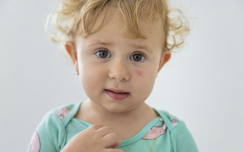 Picada de Mosquito em Bebês: prevenção, sintomas e tratamento